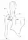 Fig. 01 - Buffer for femoral head and neck excision