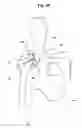 Fig. 04 - Buffer for femoral head and neck excision