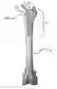 Fig. 01 - Hip stem prosthesis with a porous collar to allow for bone ingrowth