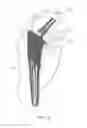 Fig. 07 - Hip stem prosthesis with a porous collar to allow for bone ingrowth