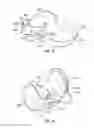Fig. 14 - Prosthetic knee implant systems and methods with linked tibial rotation