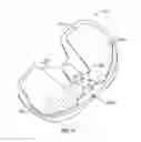 Fig. 17 - Prosthetic knee implant systems and methods with linked tibial rotation