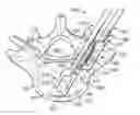 Fig. 01 - MODULAR INTERBODY FUSION SYSTEMS AND METHODS