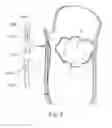 Fig. 06 - INTERCHANGEABLE LOCAL INTERFACE PROSTHETIC SOCKET APPARATUS AND SYSTEM