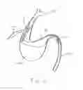 Fig. 03 - Stent