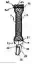 Fig. 01 - Stent with one-way sock valve