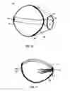 Fig. 07 - Stent with one-way sock valve