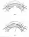 Fig. 02 - Method and apparatus for treating an ocular disorder