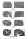 Fig. 04 - METHOD FOR TREATING INTESTINAL FIBROSIS