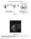 Fig. 02 - Composition and method for detection of demineralisation