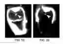 Fig. 06 - Composition and method for detection of demineralisation