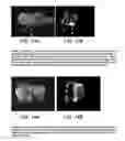 Fig. 10 - Composition and method for detection of demineralisation