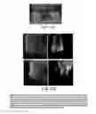 Fig. 13 - Composition and method for detection of demineralisation