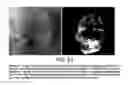 Fig. 16 - Composition and method for detection of demineralisation