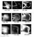 Fig. 17 - Composition and method for detection of demineralisation