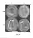 Fig. 03 - Biodegradable hydrogel for tissue expansion