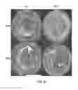 Fig. 11 - Biodegradable hydrogel for tissue expansion