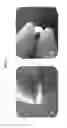 Fig. 03 - Injectable, flexible hydroxyapatite-silk foams for osteochondral and dental repair