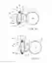 Fig. 09 - Ventricular cuff
