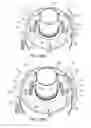 Fig. 38 - Ventricular cuff