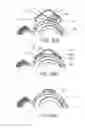 Fig. 40 - Ventricular cuff
