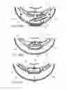 Fig. 41 - Ventricular cuff