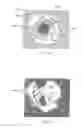 Fig. 58 - Ventricular cuff