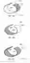 Fig. 21 - Establishing continuity between a shield within an implantable medical lead and a shield within an implantable lead extension