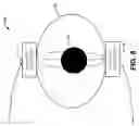 Fig. 07 - SYSTEMS AND METHODS FOR TRANSCUTANEOUS DIRECT CURRENT BLOCK TO ALTER NERVE CONDUCTION