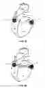 Fig. 04 - Method and device for three-stage atrial cardioversion therapy