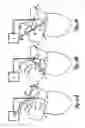 Fig. 08 - Method and device for three-stage atrial cardioversion therapy