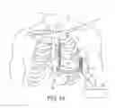 Fig. 02 - System and method for sensing and detection in an extra-cardiovascular implantable cardioverter defibrillator