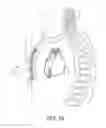 Fig. 03 - System and method for sensing and detection in an extra-cardiovascular implantable cardioverter defibrillator