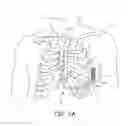 Fig. 04 - System and method for sensing and detection in an extra-cardiovascular implantable cardioverter defibrillator