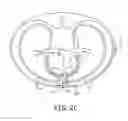 Fig. 06 - System and method for sensing and detection in an extra-cardiovascular implantable cardioverter defibrillator