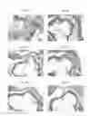 Fig. 04 - METHODS FOR INHIBITING ATHEROSCLEROSIS BY ADMINISTERING AN INHIBITOR OF PCSK9