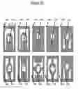 Fig. 26 - Methods and compositions for detecting multiple analytes with a single signal