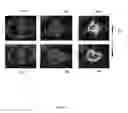 Fig. 03 - Predicting immunotherapy response in non-small cell lung cancer with serial radiomics