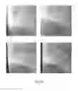 Fig. 09 - Enhanced imaging of a vascular treatment