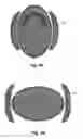 Fig. 05 - Fixation of a bone conduction floating mass transducer