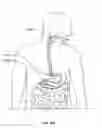 Fig. 226 - Fluid distribution device for a multiple viewing elements endoscope