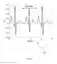 Fig. 05 - Low-distortion ECG denoising
