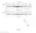 Fig. 09 - Low-distortion ECG denoising