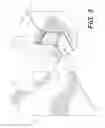 Fig. 04 - Biopsy punch device and method