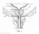 Fig. 05 - SHEATH ASSEMBLY FOR A TRANSURETHRAL PROCEDURE
