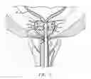 Fig. 06 - SHEATH ASSEMBLY FOR A TRANSURETHRAL PROCEDURE