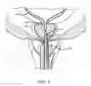 Fig. 09 - SHEATH ASSEMBLY FOR A TRANSURETHRAL PROCEDURE