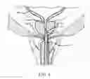 Fig. 10 - SHEATH ASSEMBLY FOR A TRANSURETHRAL PROCEDURE