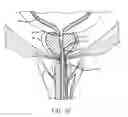 Fig. 11 - SHEATH ASSEMBLY FOR A TRANSURETHRAL PROCEDURE