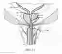 Fig. 12 - SHEATH ASSEMBLY FOR A TRANSURETHRAL PROCEDURE